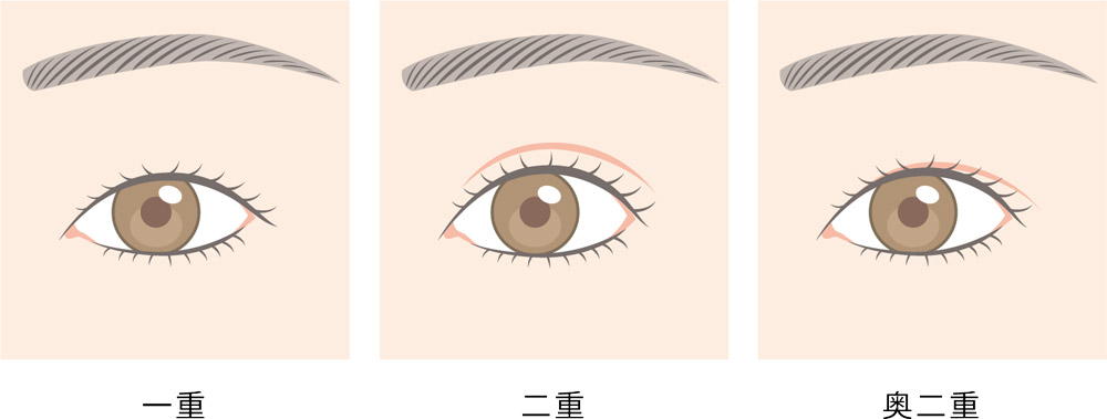 瞼の種類